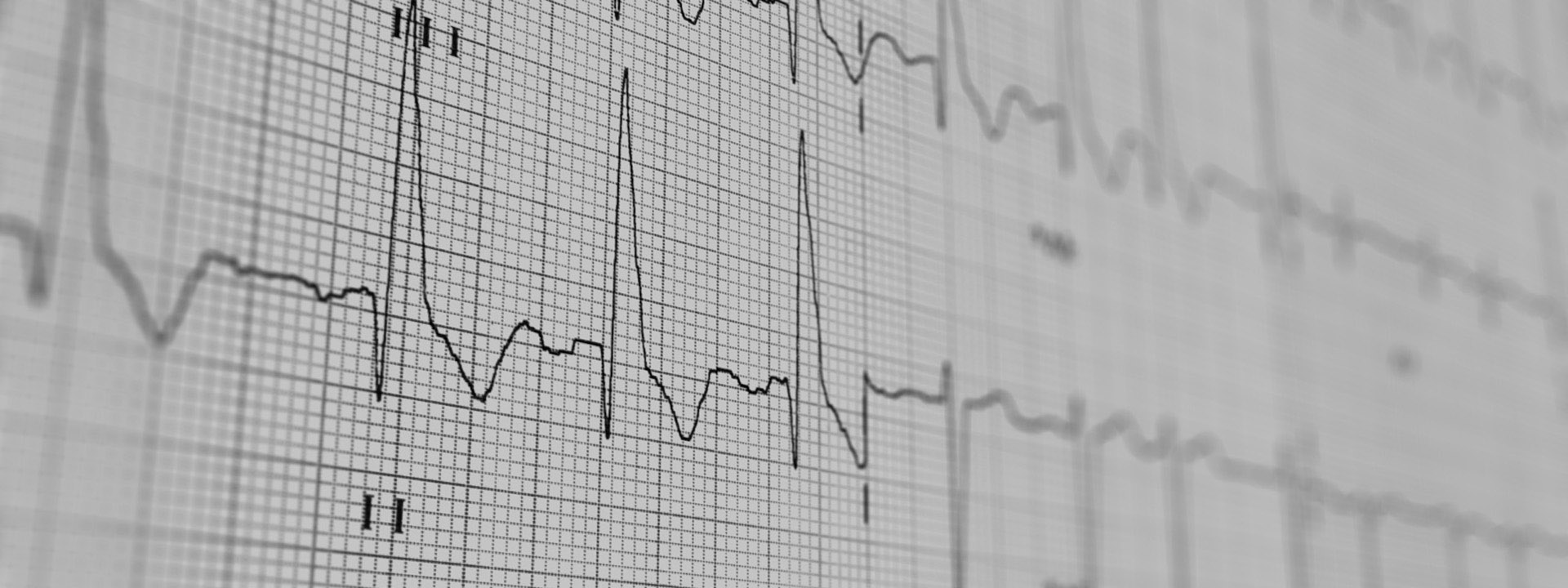 (Elektrokardiogramm) - Ableitung der elektrischen Aktivität des Herzens über die Körperoberfläche 